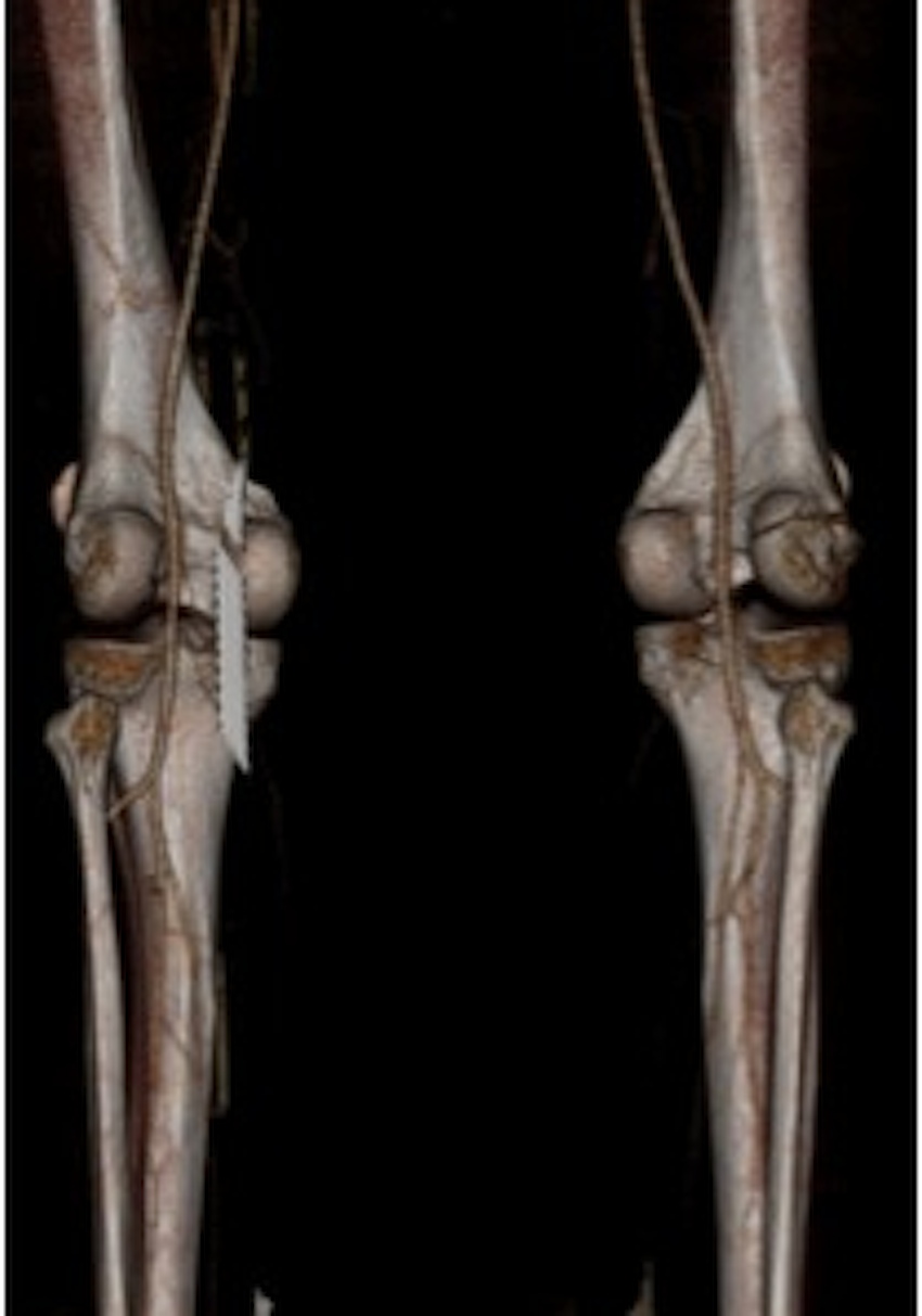 Knee Dislocation Normal CTa